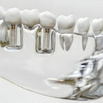 Comparing Dental Implants To Other Tooth Replacement Options_FI