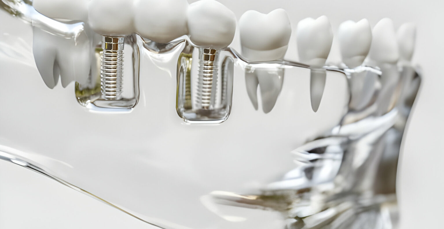 Comparing Dental Implants To Other Tooth Replacement Options_FI
