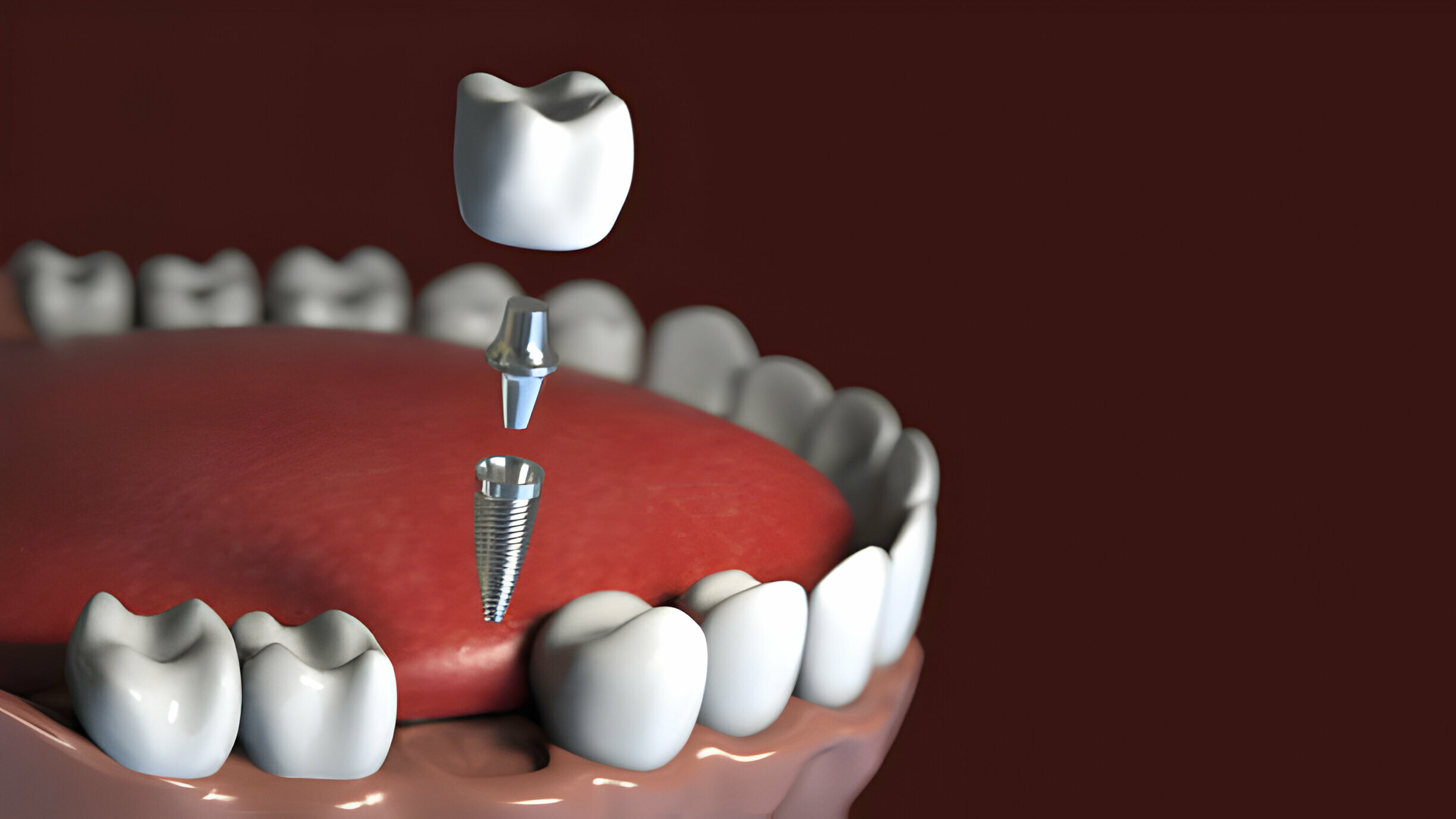 Comparing Dental Implants To Other Tooth Replacement Options_3