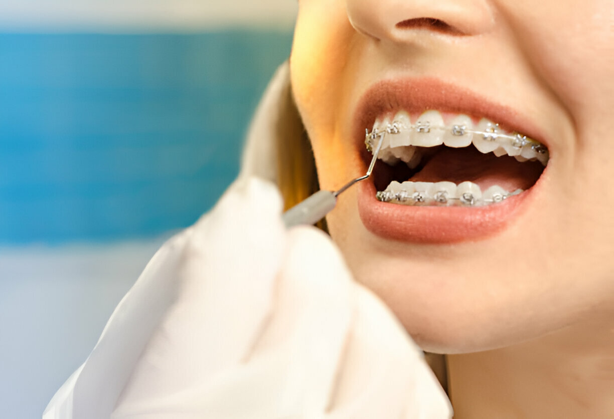 What to Expect During Your First Week with Braces_1