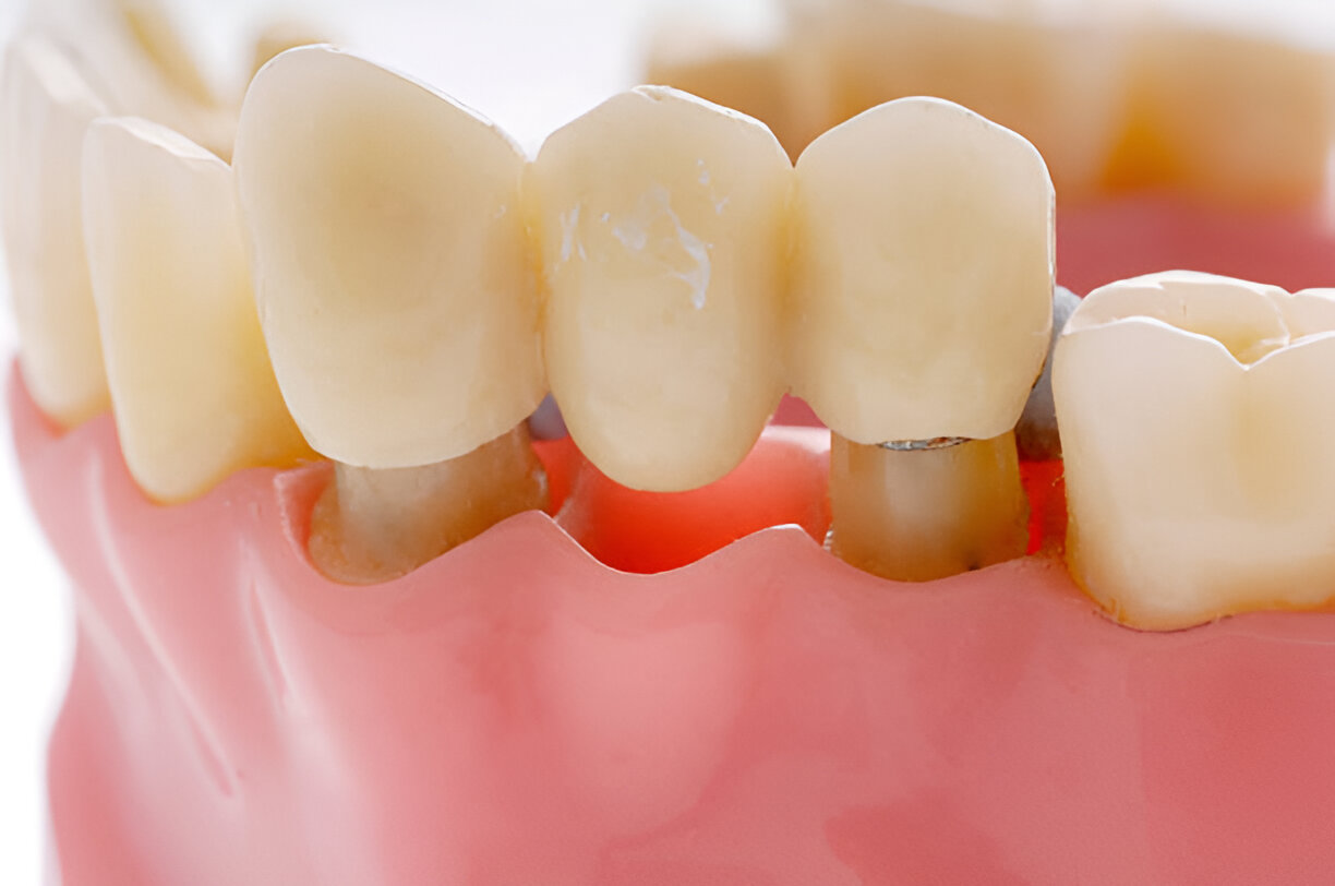 Which Dental Bridge is Right for You? Exploring the Types and Benefits_1