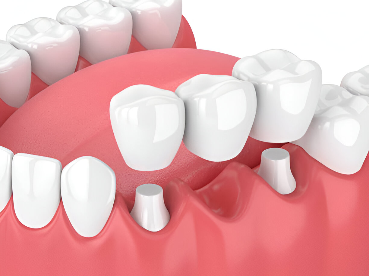 Which Dental Bridge is Right for You? Exploring the Types and Benefits_2