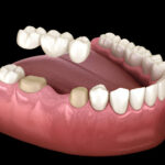 Which Dental Bridge is Right for You? Exploring the Types and Benefits_FI