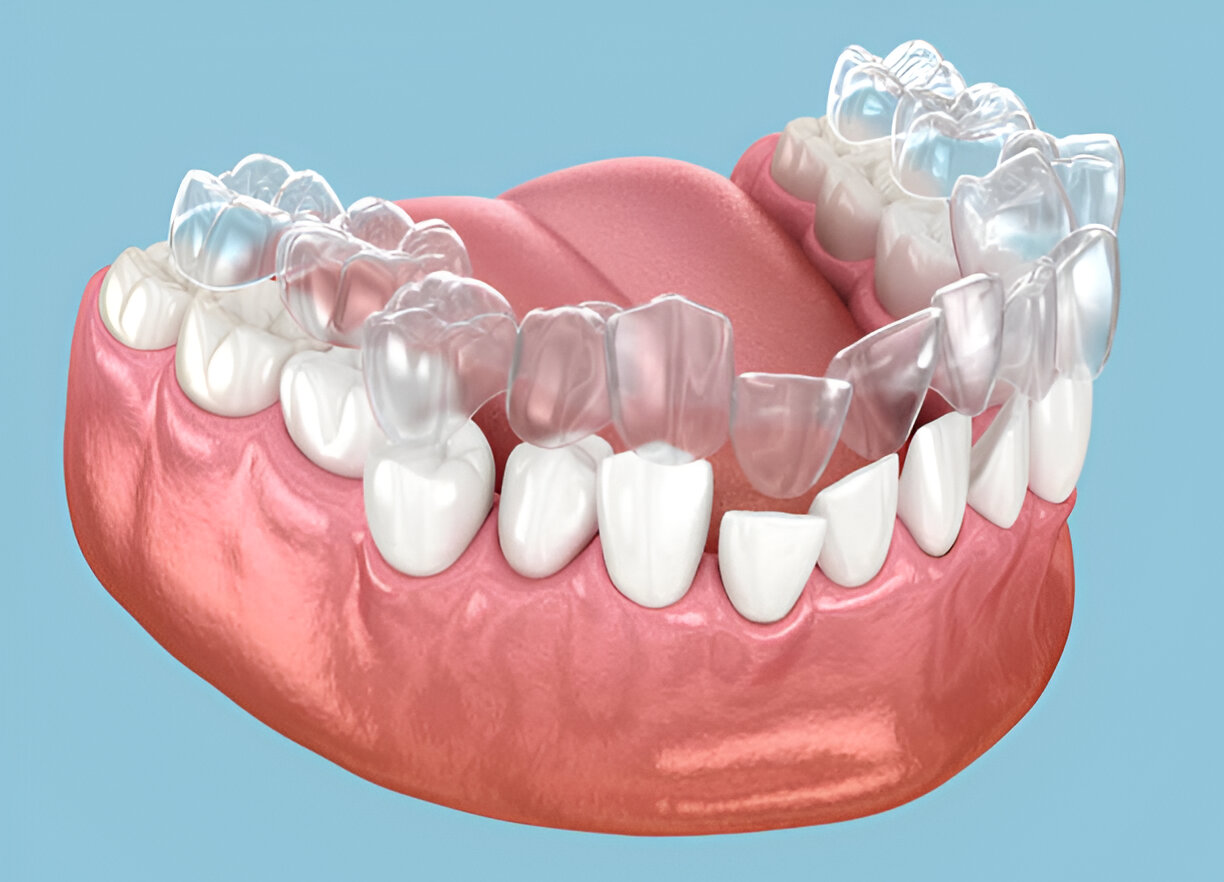 Invisalign Benefits with Expert Dentists in Texas at Taylor Dental and Braces_2