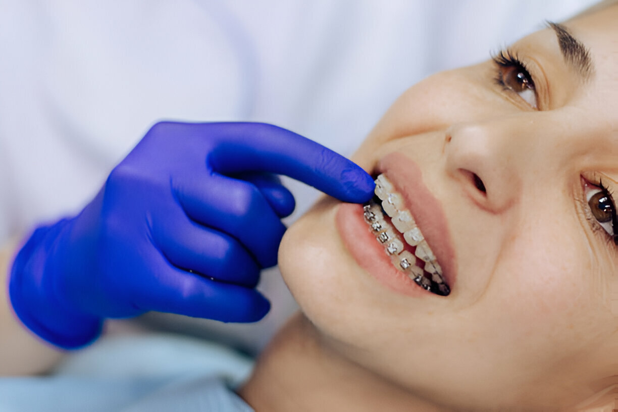 What to Expect When Getting Braces at Taylor Dental and Braces in Texas_2