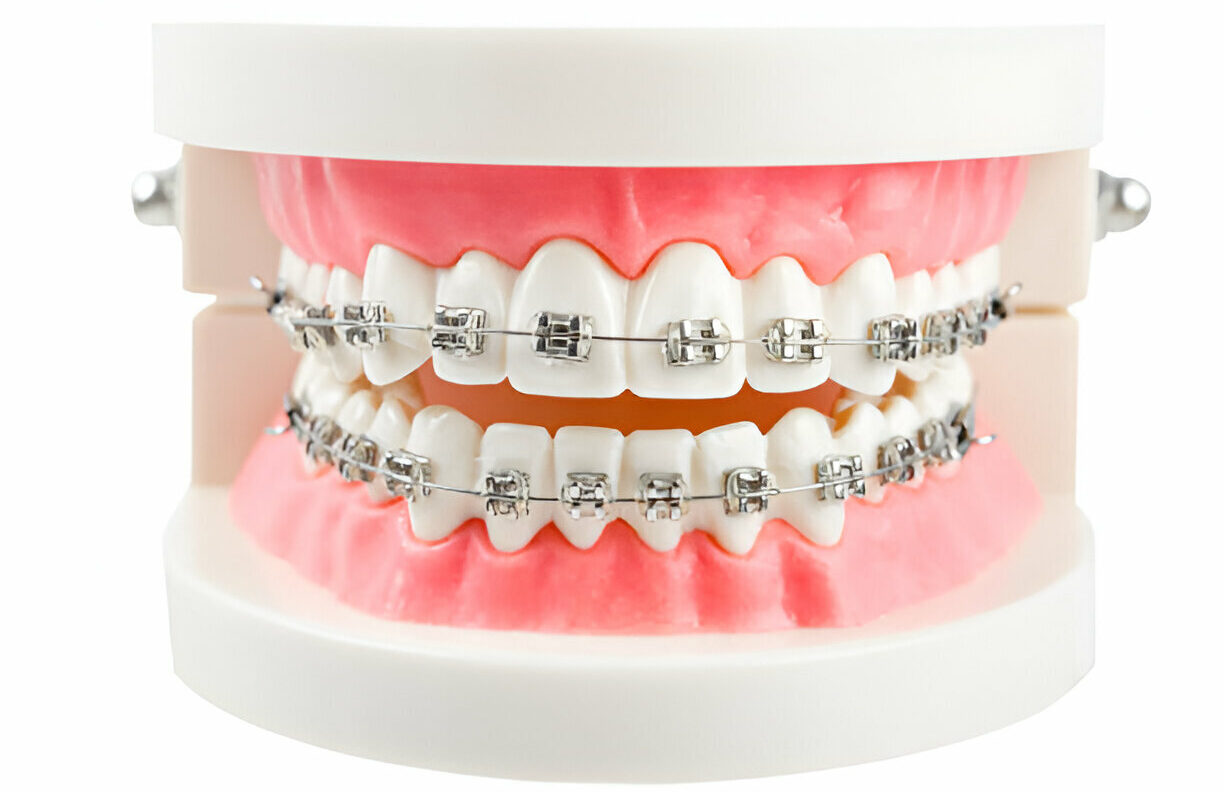 What to Expect When Getting Braces at Taylor Dental and Braces in Texas_FI