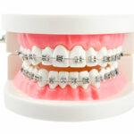 What to Expect When Getting Braces at Taylor Dental and Braces in Texas_FI